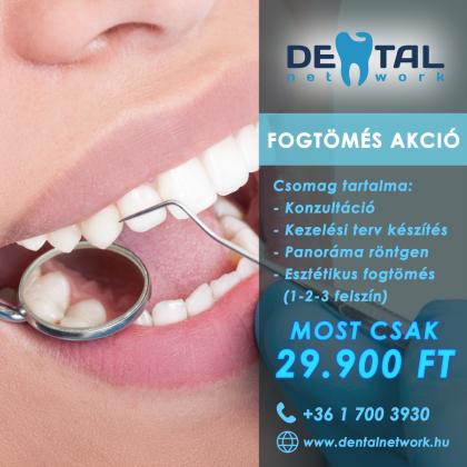 Fogtömés Akció Fogtömés Akció