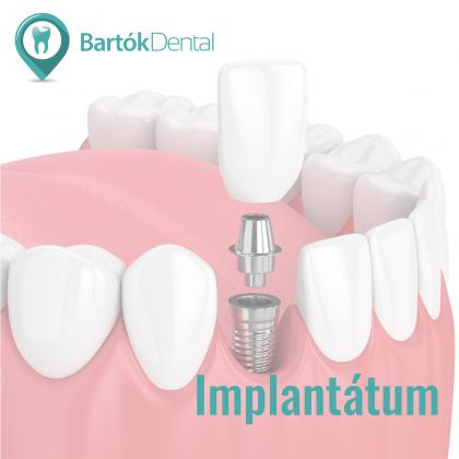 Implantológia - Éljen újra teljes életet!